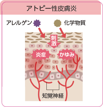 アトピー性皮膚炎