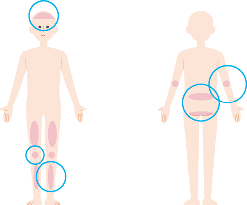 乾癬について原因イラスト