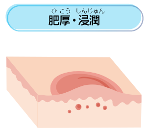 乾癬について原因イラスト